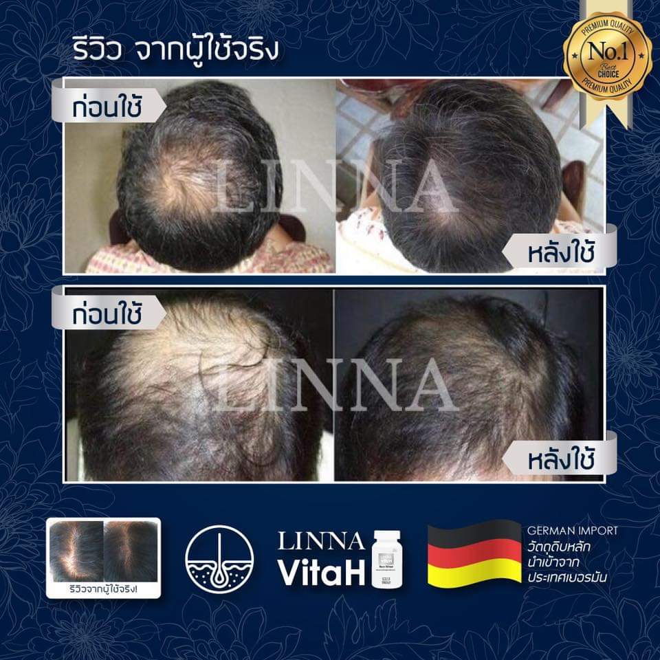 LINNA VitaH วิตามินผมหางม้า ลินนาแฮร์เซรั่ม linna hair serum แชมพู shampoo